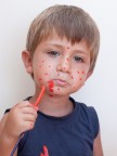 varicella