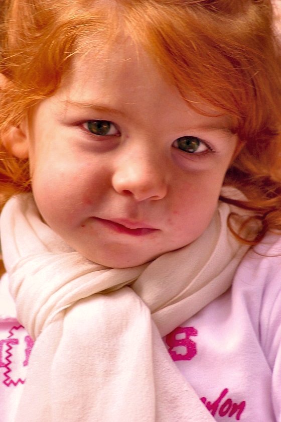 alice con varicella.jpg